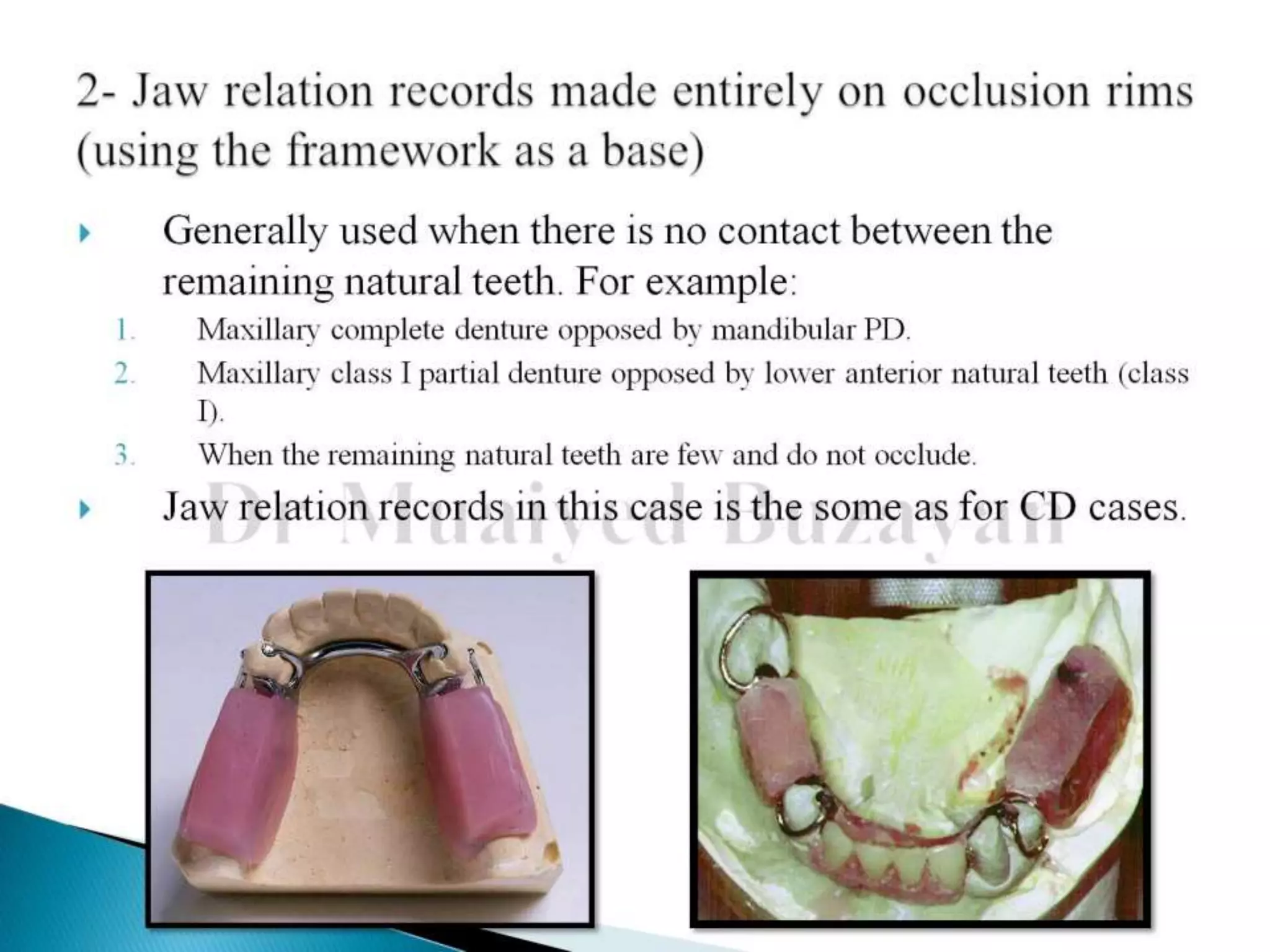 Partial Registration Rim Occlusion in removable partial denture clinical 2014-9 | PPTX