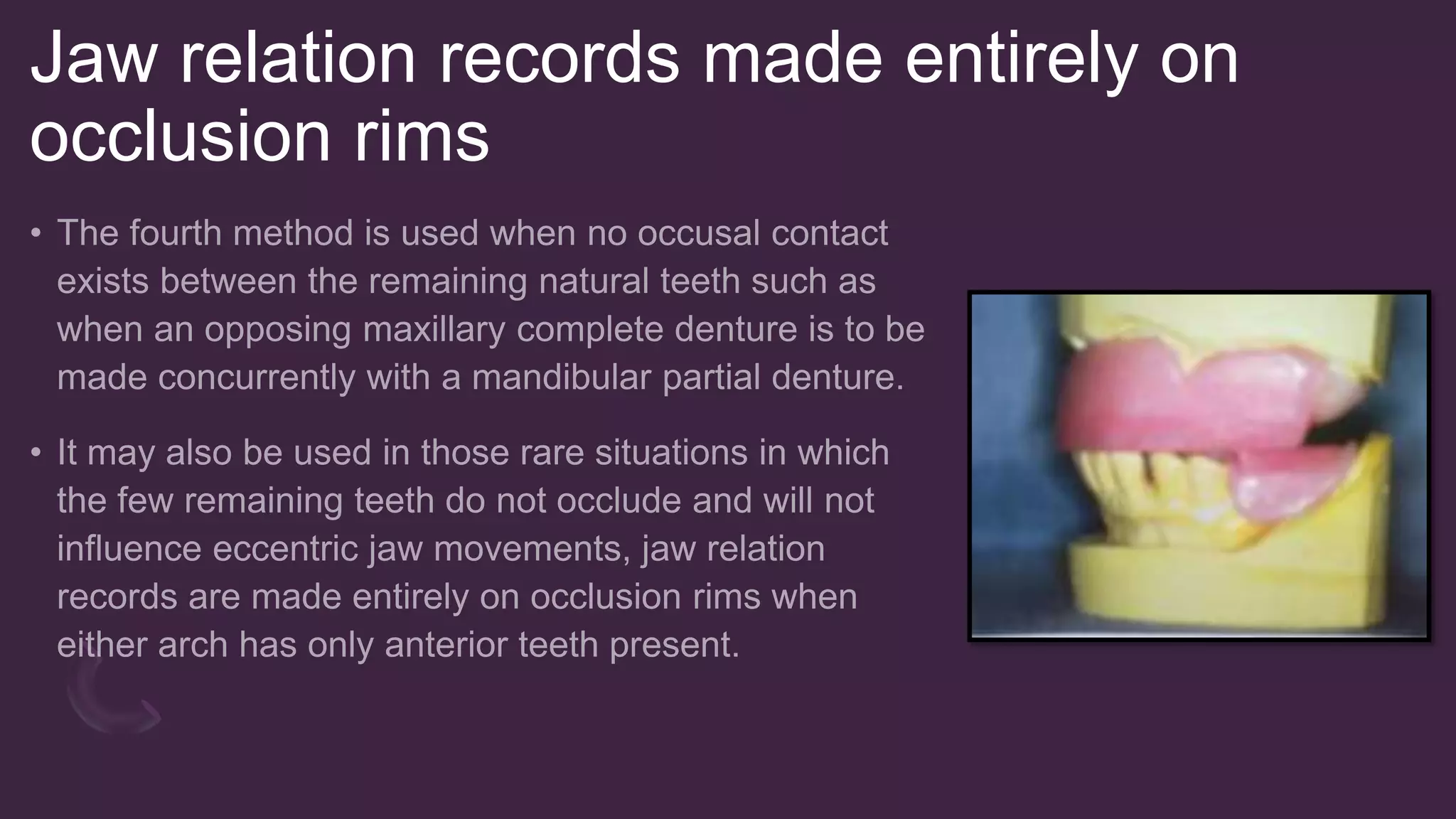 Occlusal Record Rpd Occlusal Relationship in Removable partial denture | PPTX