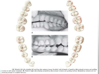 OCCLUSION | PPTX