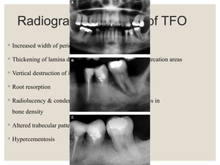 OCCLUSION & PERIODONTIUM.pptx 2025 April | PPTX