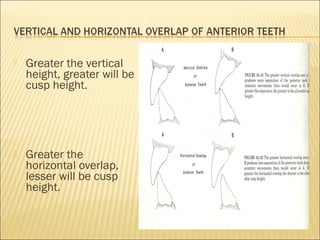    Greater the vertical
    height, greater will be
    cusp height.




   Greater the
    horizontal overlap,
    lesser will be cusp
    height.
 