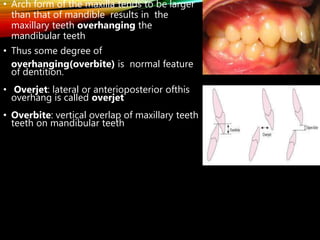 • Arch form of the maxilla tends to be larger
than that of mandible results in the
maxillary teeth overhanging the
mandibular teeth
• Thus some degree of
overhanging(overbite) is normal feature
of dentition.
• Overjet: lateral or anterioposterior ofthis
overhang is called overjet
• Overbite: vertical overlap of maxillary teeth
teeth on mandibular teeth
 