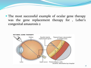  The most successful example of ocular gene therapy
was the gene replacement therapy for , Leber's
congenital amaurosis 2
18
 