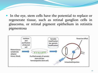  In the eye, stem cells have the potential to replace or
regenerate tissue, such as retinal ganglion cells in
glaucoma, or retinal pigment epithelium in retinitis
pigmentosa
20
 