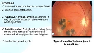 Occular manifestations in HIV AIDS .pptx