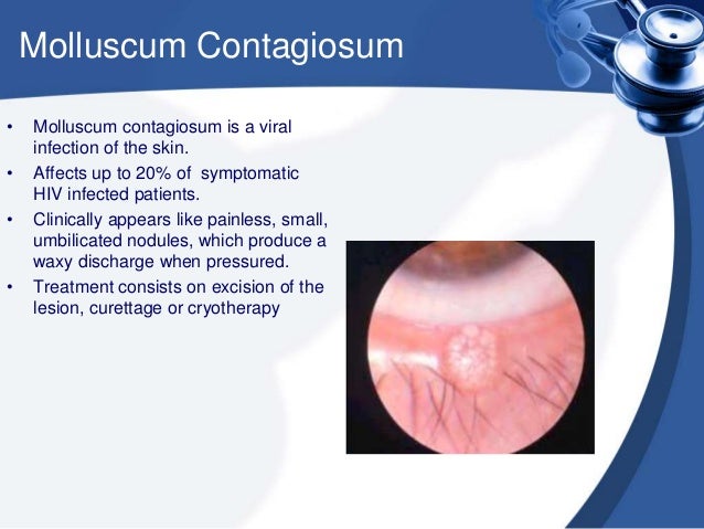 zoster skin herpes treatment HIV Occular of manifestations