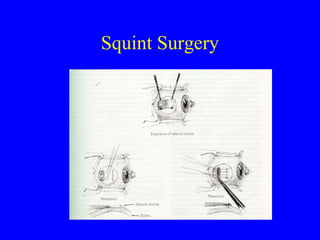 Squint Surgery
 