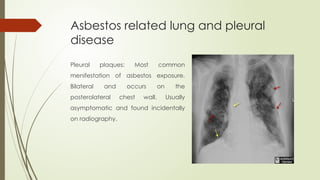 Asbestos related lung and pleural
disease
Pleural plaques: Most common
menifestation of asbestos exposure.
Bilateral and occurs on the
posterolateral chest wall. Usually
asymptomatic and found incidentally
on radiography.
 