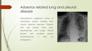 Mesothelioma: Malignant tumour of
mesothelial surface resulting from
chronic asbestos exposure. Presents
with dull aching chest pain,
breathlessness and cough. Pleural
effusion with localized pleural
thickening/mass is seen on
radiography.
Asbestos related lung and pleural
disease
 