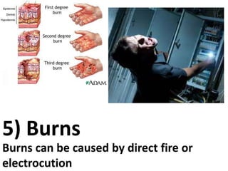 5) Burns
Burns can be caused by direct fire or
electrocution

 