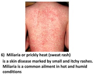 6) Miliaria or prickly heat (sweat rash)
is a skin disease marked by small and itchy rashes.
Miliaria is a common ailment in hot and humid
conditions

 