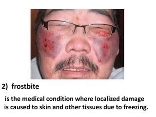 2) frostbite
is the medical condition where localized damage
is caused to skin and other tissues due to freezing.

 