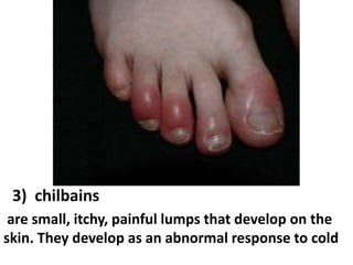 3) chilbains
are small, itchy, painful lumps that develop on the
skin. They develop as an abnormal response to cold

 