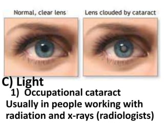 C) Light

1) Occupational cataract
Usually in people working with
radiation and x-rays (radiologists)

 