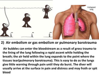 2) Air embolism or gas embolism or pulmonary barotrauma
Air bubbles can enter the bloodstream as a result of gross trauma to
the lining of the lung following a rapid ascent while holding the
breath; the air held within the lung expands to the point where the
tissues tear(pulmonary barotrauma). This is easy to do as the lungs
give little warning through pain until they do burst. The diver will
usually arrive at the surface in pain and distress and may froth or spit
blood

 
