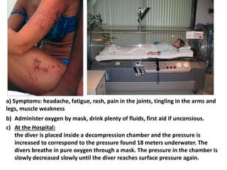 a) Symptoms: headache, fatigue, rash, pain in the joints, tingling in the arms and
legs, muscle weakness
b) Administer oxygen by mask, drink plenty of fluids, first aid if unconsious.
c) At the Hospital:
the diver is placed inside a decompression chamber and the pressure is
increased to correspond to the pressure found 18 meters underwater. The
divers breathe in pure oxygen through a mask. The pressure in the chamber is
slowly decreased slowly until the diver reaches surface pressure again.

 