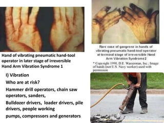 Hand of vibrating pneumatic hand-tool
operator in later stage of irreversible
Hand Arm Vibration Syndrome 1

I) Vibration
Who are at risk?
Hammer drill operators, chain saw
operators, sanders,
Bulldozer drivers, loader drivers, pile
drivers, people working
pumps, compressors and generators

 