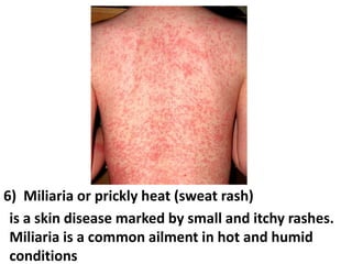 Sweat Rash Arms Occupational hazards complete | PPT