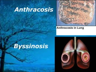 Anthracosis 
Byssinosis 
 