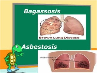 Bagassosis 
Asbestosis 
 