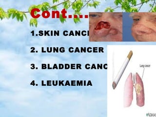 Cont...... 
.. 
1.SKIN CANCER 
2. LUNG CANCER 
3. BLADDER CANCER 
4. LEUKAEMIA 
 