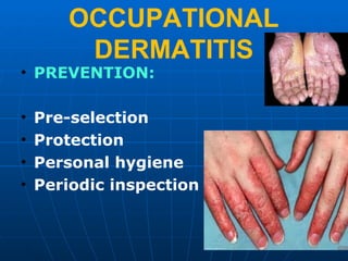 OCCUPATIONAL 
DERMATITIS 
• PREVENTION: 
• Pre-selection 
• Protection 
• Personal hygiene 
• Periodic inspection 
 