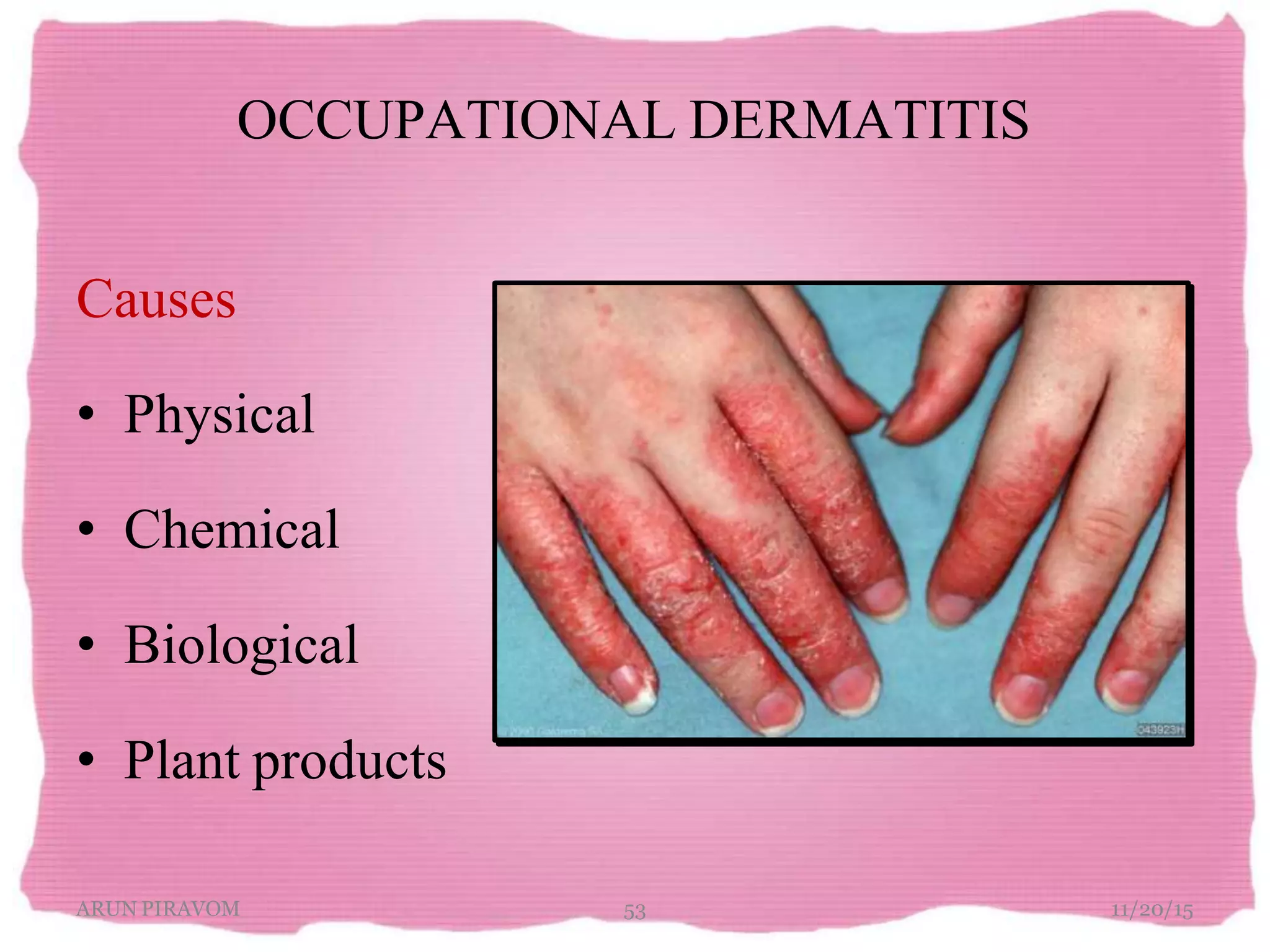 OCCUPATIONAL DERMATITIS
Causes
• Physical
• Chemical
• Biological
• Plant products
11/20/15ARUN PIRAVOM 53
 