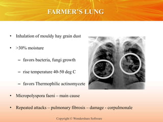 Copyright © Wondershare Software
FARMER’S LUNG
• Inhalation of mouldy hay grain dust
• >30% moisture
– favors bacteria, fungi growth
– rise temperature 40-50 deg C
– favors Thermophilic actinomycete
• Micropolyspora faeni – main cause
• Repeated attacks – pulmonary fibrosis – damage - corpulmonale
 