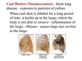 • Asbestosis - inhalation of fibrous minerals of asbestos
• Bauxite fibrosis - exposure to bauxite fumes which
contain alu...