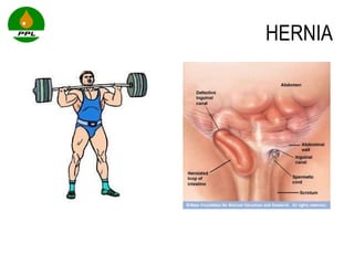 HERNIA 