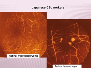 Japanese CS2 workers
Retinal hemorrhages
Retinal microaneurysms
 