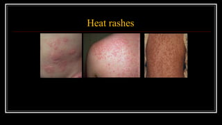 Occupational heat stress and occupational health services | PPTX