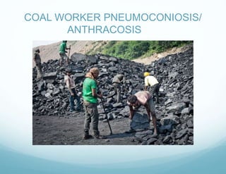 COAL WORKER PNEUMOCONIOSIS/
ANTHRACOSIS
 