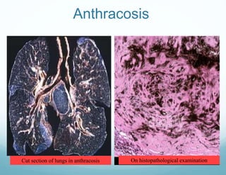 Anthracosis
Cut section of lungs in anthracosis On histopathological examination
 