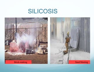 Brick-making Sand blasting
SILICOSIS
 