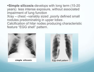 Simple silicosis-develops with long term (15-20
years) less intense exposure, without associated
impairment of lung function
Xray – chest –variably sized ,poorly defined small
nodules predominating in upper lobes .
Calcification of hilar nodes producing characteristic
feature “EGG shell” pattern.
Egg shell pattern
 