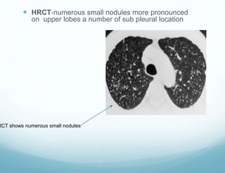  HRCT-numerous small nodules more pronounced
on upper lobes a number of sub pleural location
RCT shows numerous small nodules
 