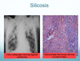 Silicosis
Chest radiography showing Eggshell
calcification
Polarized light microscopy showing
Crystals of silica
 