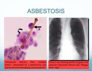 ASBESTOSIS
Translucent asbestos fiber (straight
arrow) surrounded by a protein-iron coat
and an alveolar macrophage (curved arrow)
Chest x-ray showing Small, irregular oval
opacities Interstitial fibrosis and “Shaggy
heart sign”
 