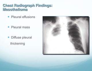 Chest Radiograph Findings:
Mesothelioma
 Pleural effusions
 Pleural mass
 Diffuse pleural
thickening
 