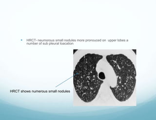 HRCT- neumorous small nodules more pronouced on upper lobes a
number of sub pleural loacation
HRCT shows numerous small nodules
 