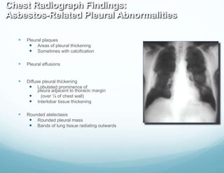 Chest Radiograph Findings:
Asbestos-Related Pleural Abnormalities
 Pleural plaques
 Areas of pleural thickening
 Sometimes with calcification
 Pleural effusions
 Diffuse pleural thickening
 Lobulated prominence of
pleura adjacent to thoracic margin
 (over ¼ of chest wall)
 Interlobar tissue thickening
 Rounded atelectasis
 Rounded pleural mass
 Bands of lung tissue radiating outwards
 