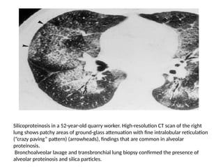 Occupational lung disease radiology imaging-mahesh.pptx