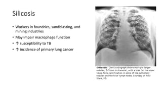 Silicosis
• Workers in foundries, sandblasting, and
mining industries
• May impair macrophage function
• ↑ susceptibility to TB
• ↑ incidence of primary lung cancer
 