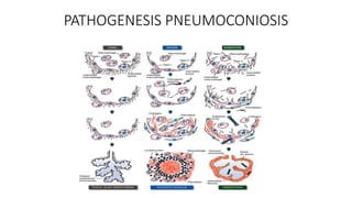 PATHOGENESIS PNEUMOCONIOSIS
 