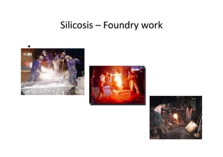 Silicosis – Foundry work
•
 