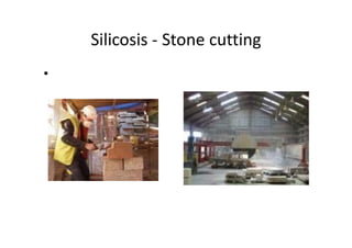 Silicosis ‐ Stone cutting
•
 