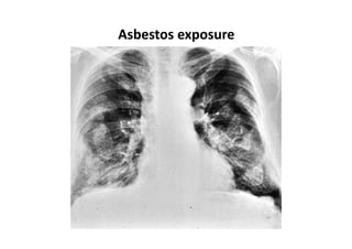 Asbestos exposure
 