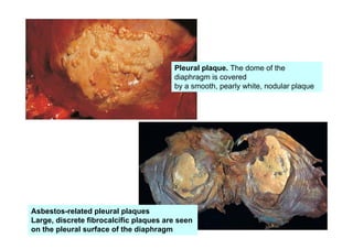 Pleural plaque. The dome of the
diaphragm is covered
by a smooth, pearly white, nodular plaque
Asbestos-related pleural plaques
Large, discrete fibrocalcific plaques are seen
on the pleural surface of the diaphragm
 