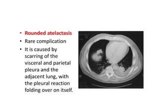 • Rounded atelactasis
• Rare complication
• It is caused by
scarring of the
visceral and parietal
pleura and the
adjacent lung, with
the pleural reaction
folding over on itself.
 